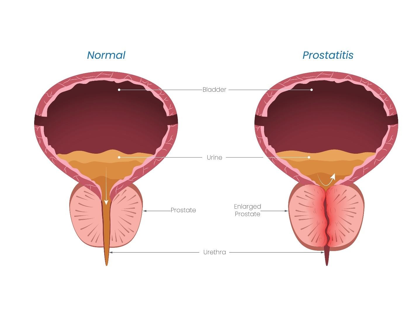 Causes of enlarged prostate BPH Singapore