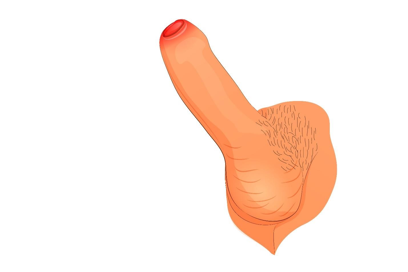 Causes of tight foreskin phimosis in adults Singapore