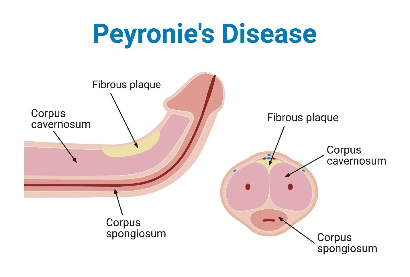 Peyronie’s disease causes penile plaque and scar tissue formation