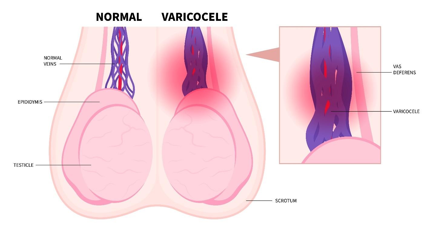 Grade 1 2 3 varicocele classification Singapore
