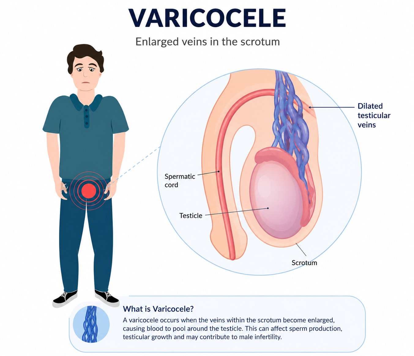 Varicocele Singapore